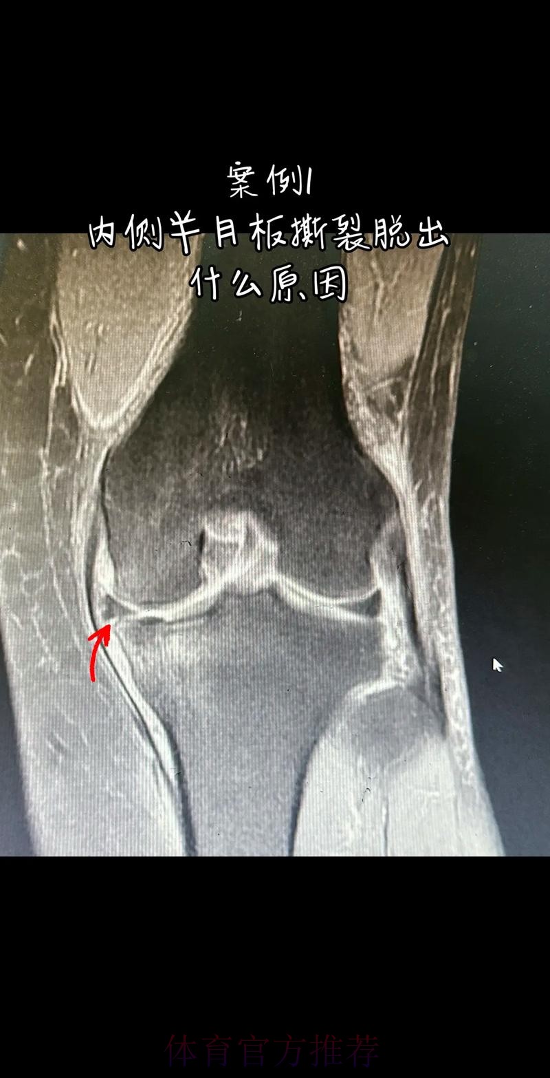 官方：阿拉巴左膝内侧半月板撕裂 预计伤缺6-8周
